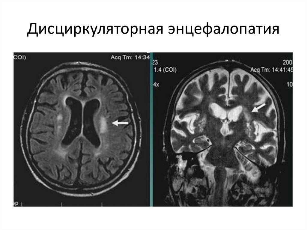 Дисциркуляторные изменения головного мозга что это такое. Дисциркуляторная энцефалопатия мрт. Дэп на мрт. Кт картина дисциркуляторной энцефалопатии. Дисциркуляторная энцефалопатия на кт.
