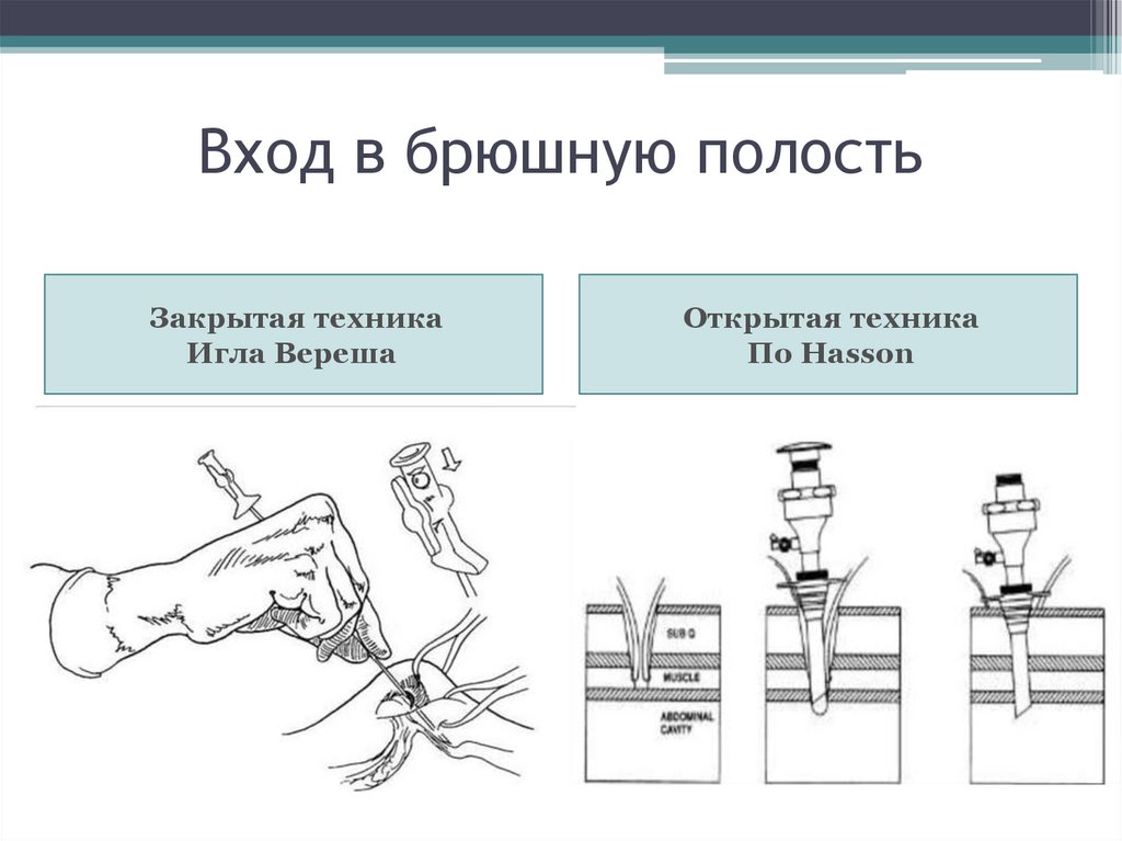 Вход в брюшную полость