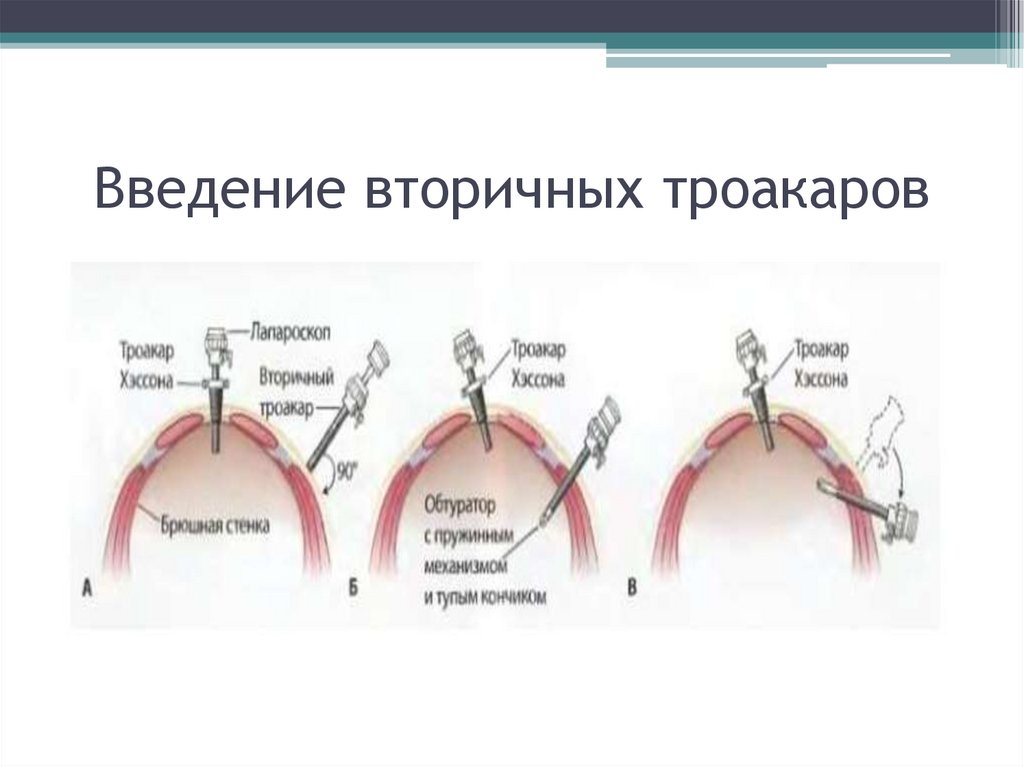Введение вторичных троакаров