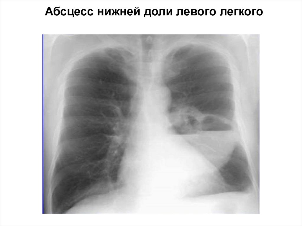 1 легкое меньше другого. Рентген грудной клетки абсцесс легкого. Абсцесс левого легкого рентген. Абсцесс рентген снимок. Абсцесс легкого рентгенограмма.