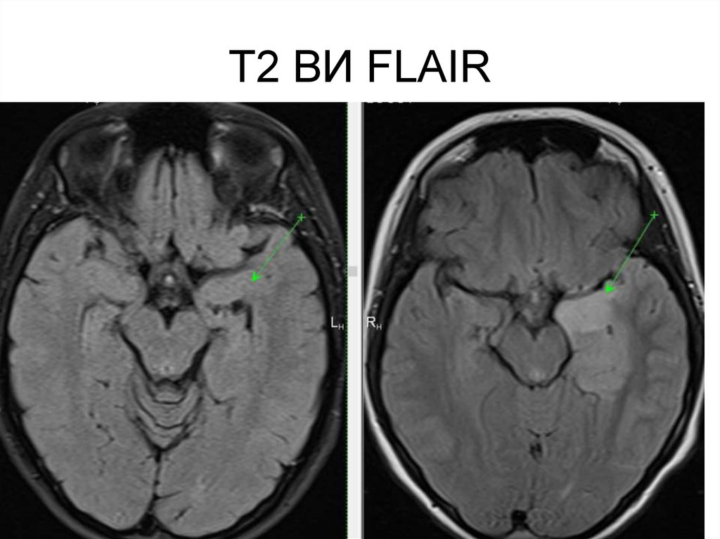 Т2 ВИ FLAIR