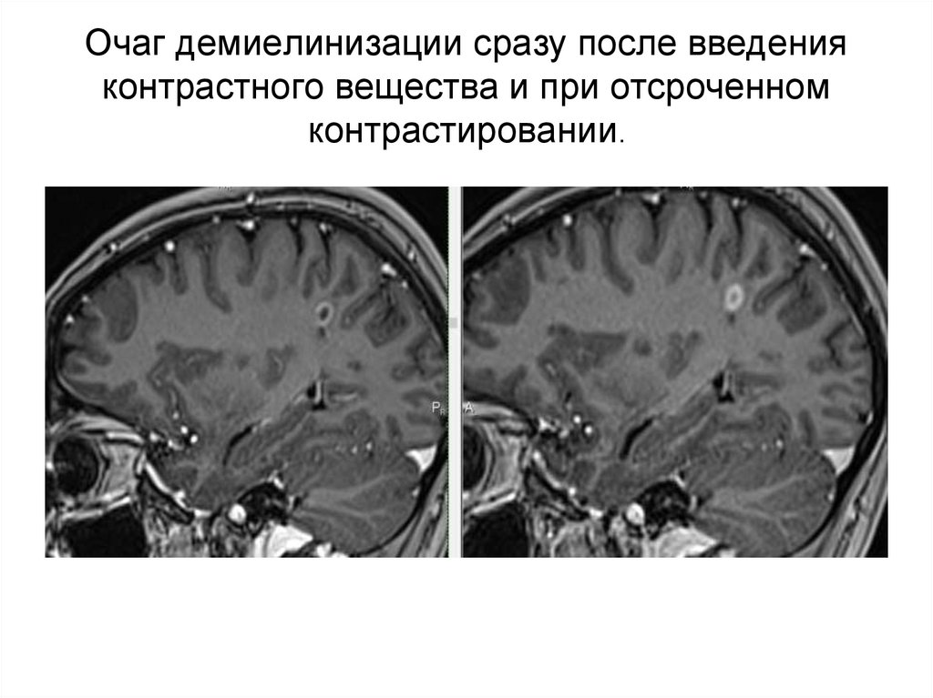 Очаг демиелинизации сразу после введения контрастного вещества и при отсроченном контрастировании.