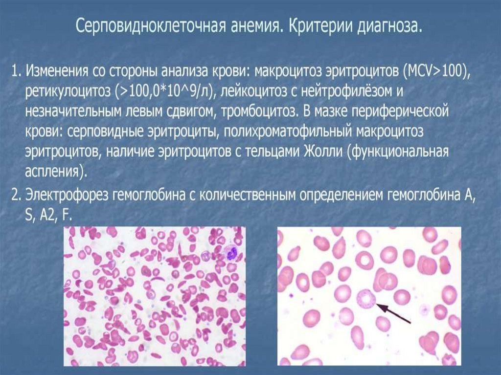 Тромбоцитоз лейкоцитоз. Серповидноклеточная анемия картина крови. Серповидноклеточная анемия мазок крови. Картина крови при серповидноклеточной анемии. Анализ крови при серповидноклеточной анемии.