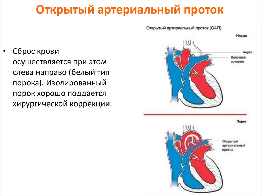 Оап у новорожденных. Открытый артериальный (боталлов) проток. Врожденный порок сердца открытый артериальный проток. Артериальный боталлов проток. Открытый артериальный (боталлов) проток (ОАП).