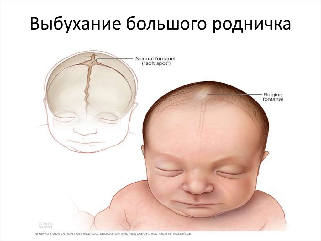 Нормальный родничок. Родничок у новорожденных где находится норма. Большой и малый Родничок у новорожденного. Сосцевидный Родничок у новорожденных. Форма головы у новорожденных.