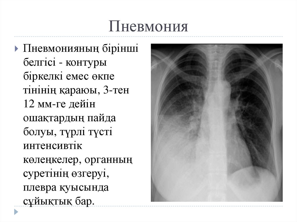 Пневмония - презентация онлайн