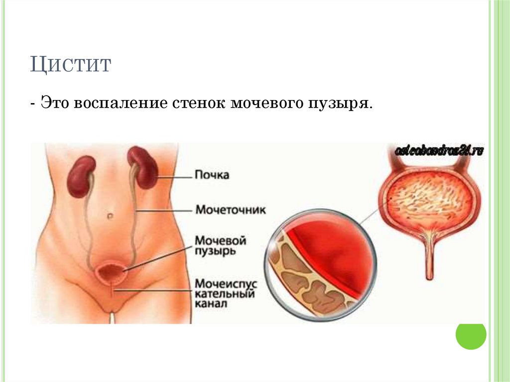 Презентация на тему цистит