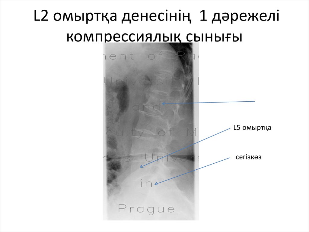 L2 омыртқа денесінің 1 дәрежелі компрессиялық сынығы