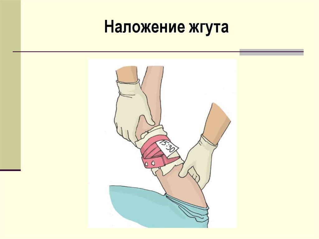 Тугой жгут. Капиллярное кровотечение наложение жгута. Наложение жгута при кровотечениях алгоритм. Наложение жгута на конечность. Кровотечения презентация.