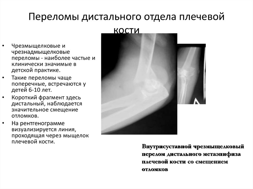 Операция перелом локтевого отростка