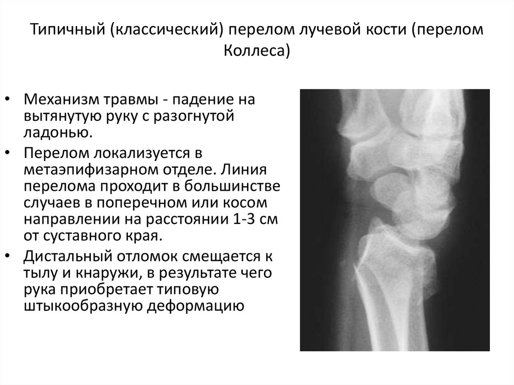 Перелом луча в типичном месте карта вызова скорой помощи локальный статус