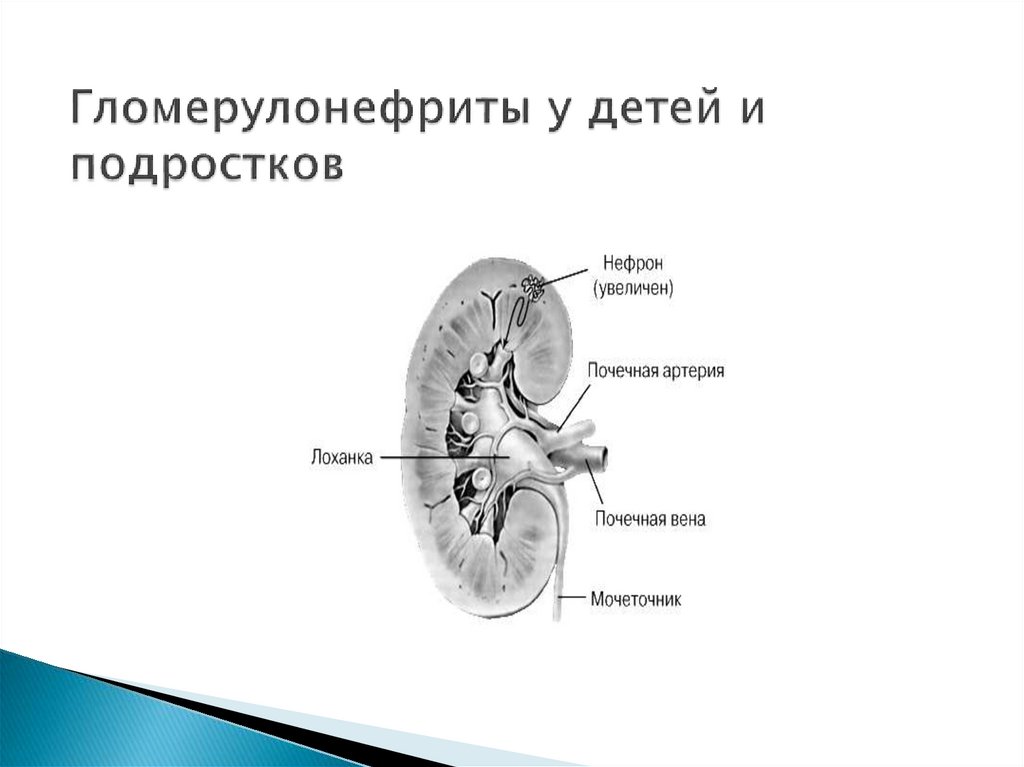 Гломерулонефрит у детей презентация