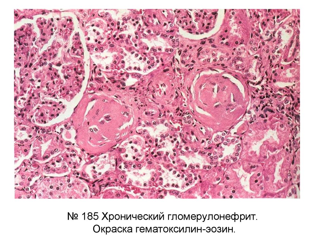 Заболевания почек - презентация онлайн