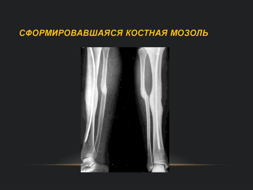 Метастатическое поражение кости. Метастатическое поражение костей. Формирование костной мозоли патоморфология. Как выглядит костная мозоль у собаки.