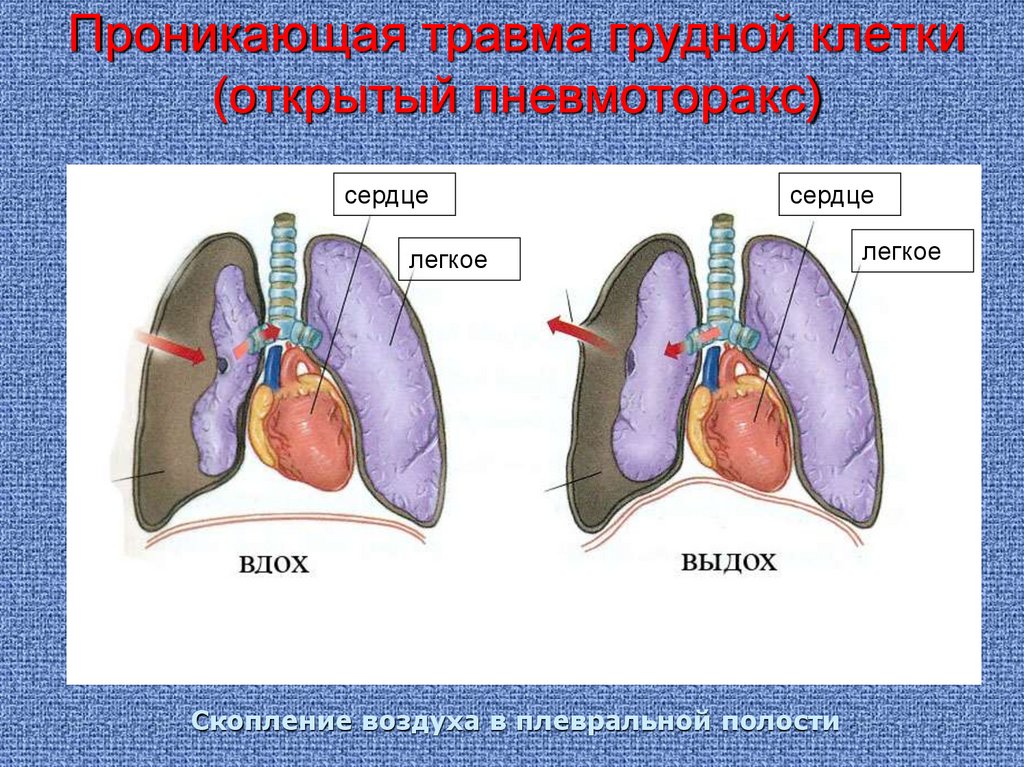 Проникающее ранение грудной