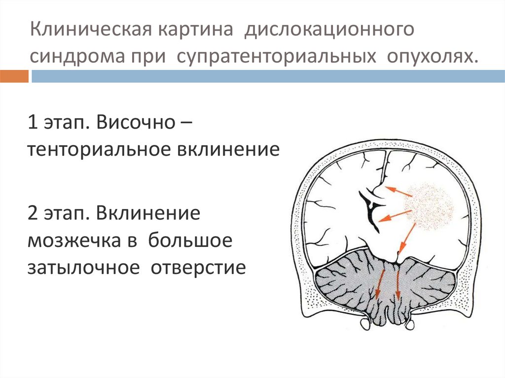 Очаговые симптомы головного мозга