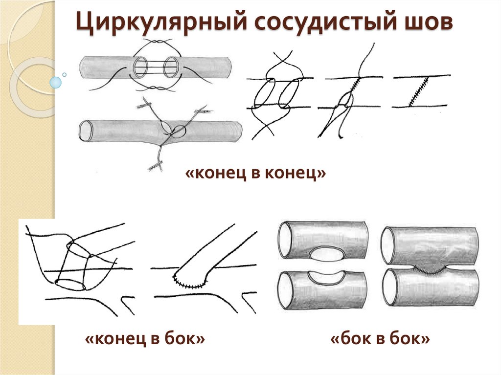 Сосудистый шов история