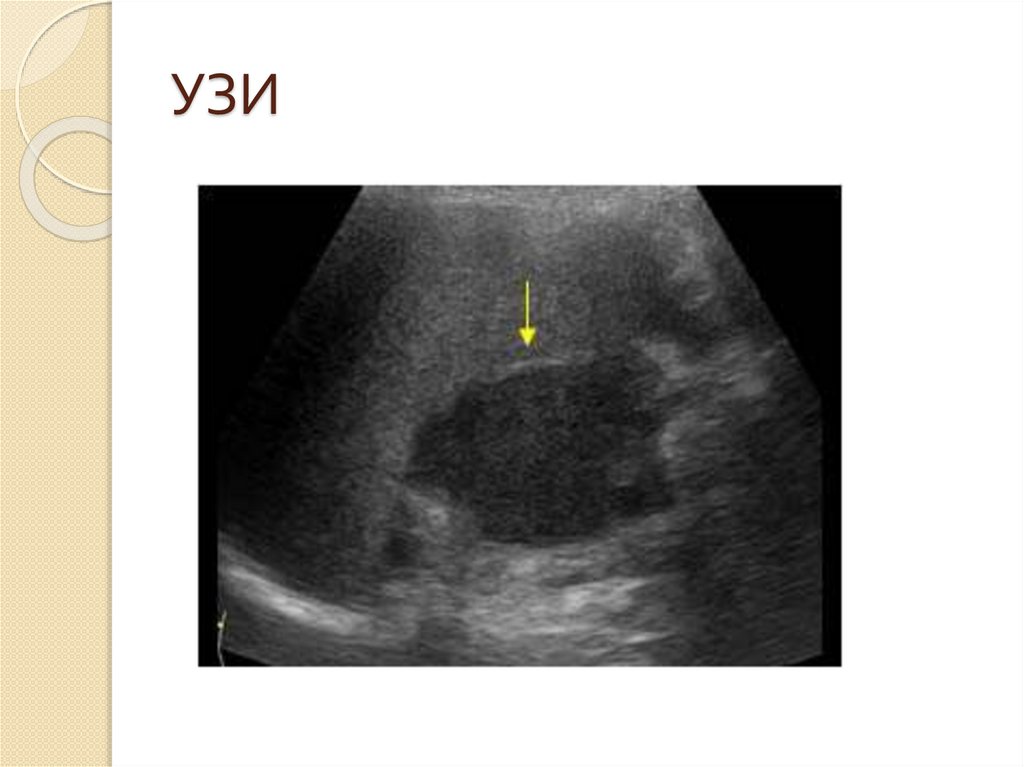 УЗИ