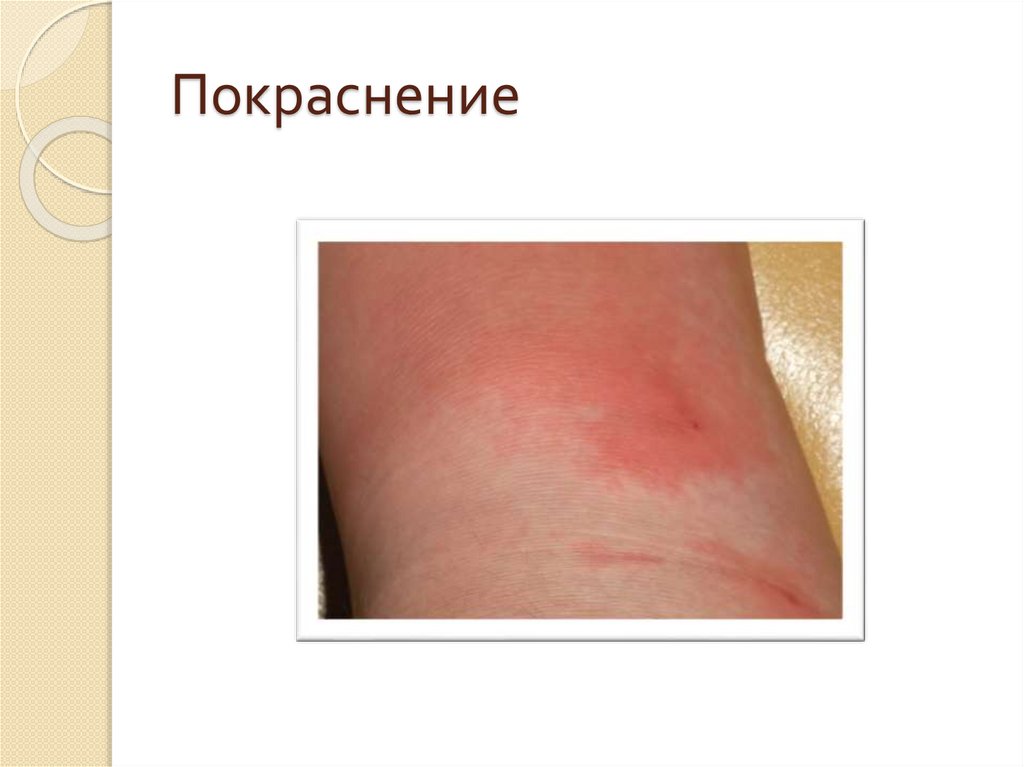 Покраснение