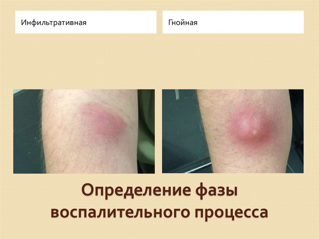 Определение фазы воспалительного процесса