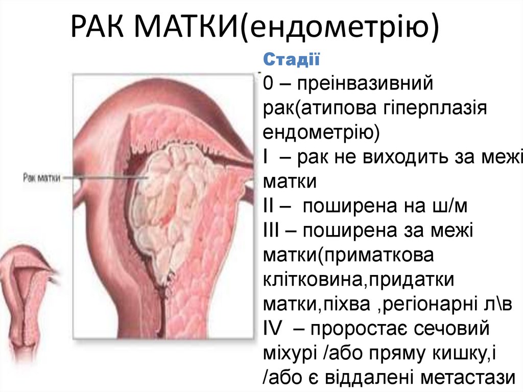 РАК МАТКИ(ендометрію)