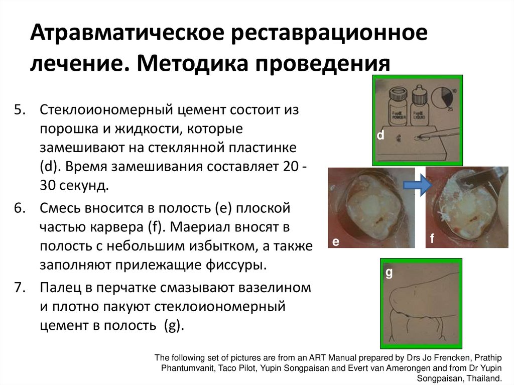 Атравматическое реставрационное лечение. Методика проведения