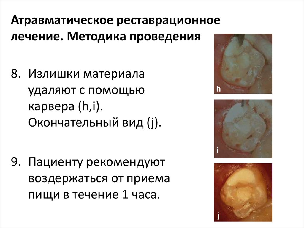 Атравматическое реставрационное лечение. Методика проведения