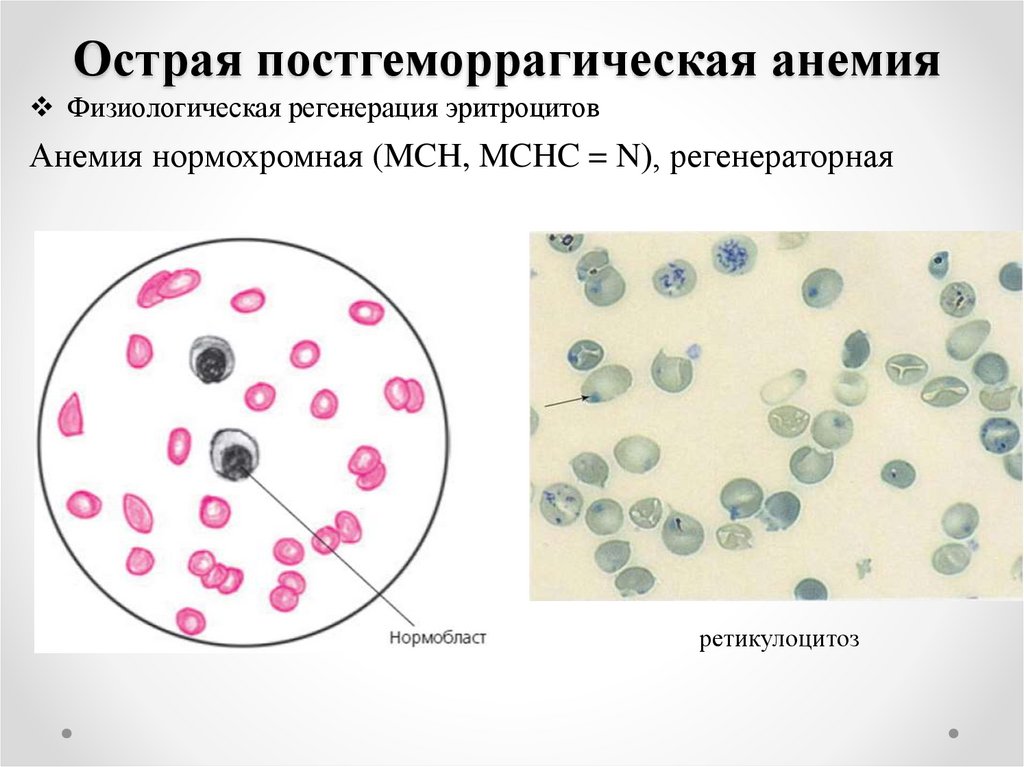 Постгеморрагические анемии картина крови