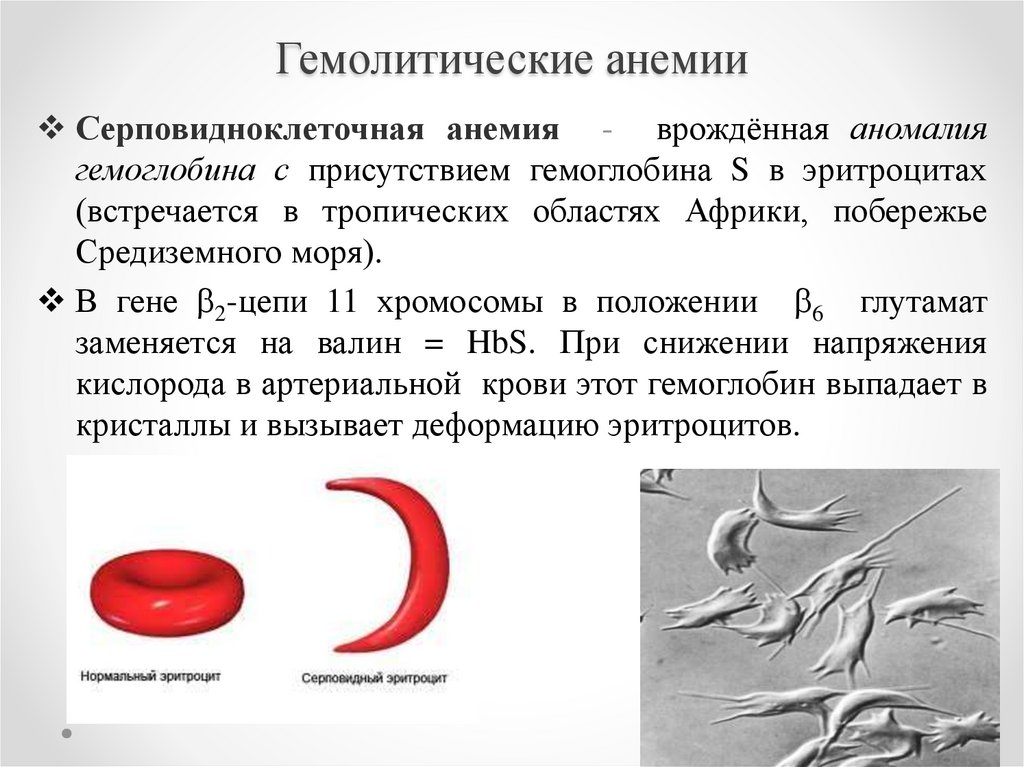 Распад крови. Клинические симптомы гемолитической анемии. Гемолитическая анемия эритроциты и гемоглобин. Серповидно клеточная анемия картина крови. Серповидноклеточная анемия эритроциты.