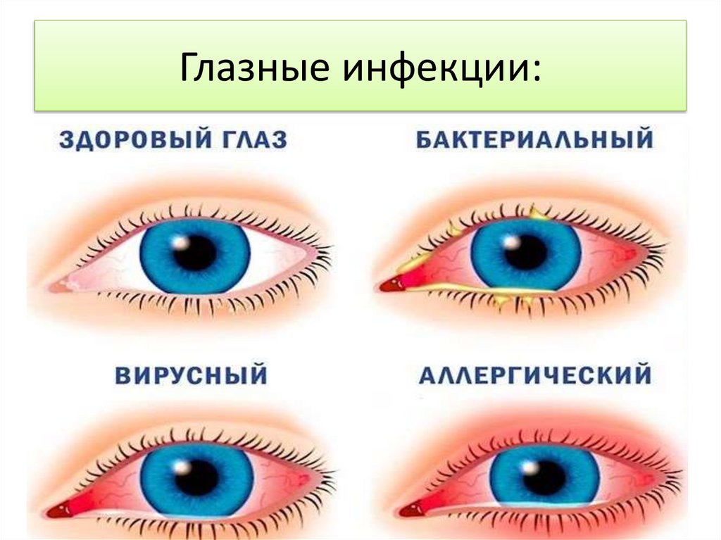 5 заболеваний глаз. Инфекционные заболевания глаз. Глазные инфекции у людей. Разные глазные инфекции названиями.
