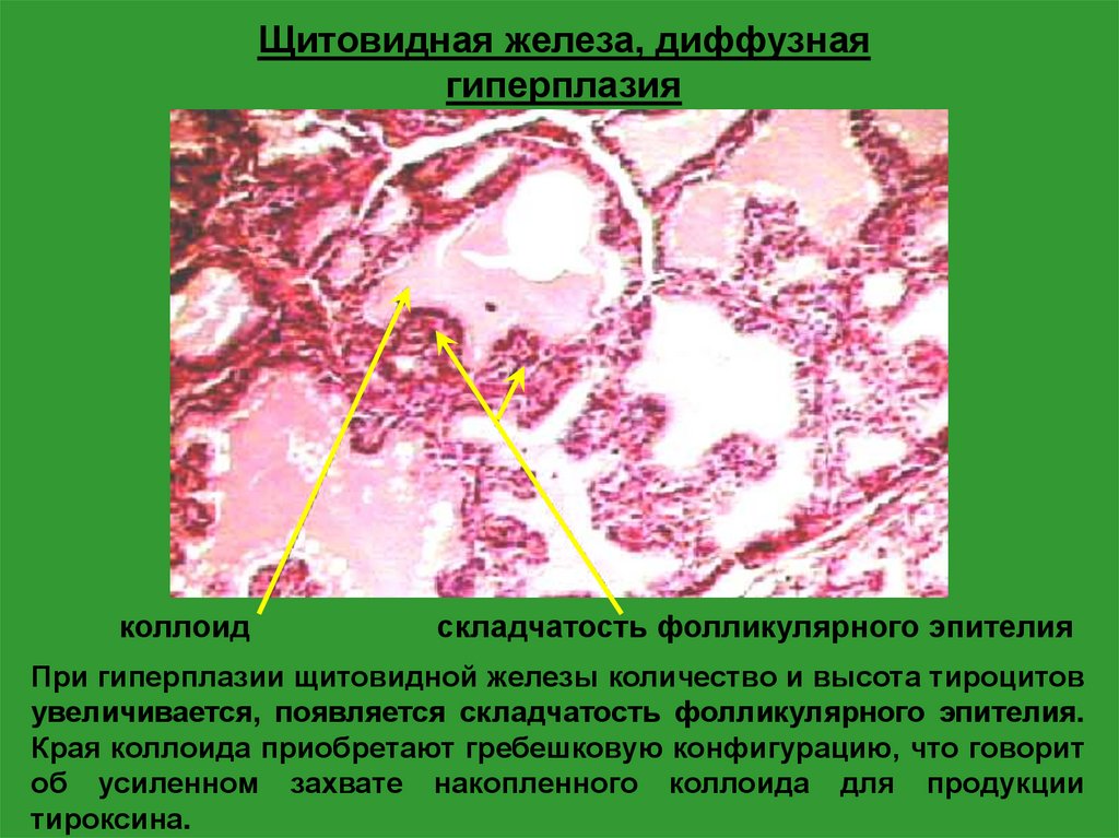 Диффузно узловая гиперплазия железы. Диффузно Узловая гиперплазия щитовидной железы. Узловая гиперплазия щитовидной железы 8мм. Мелкоузловая коллоидная гиперплазия щитовидной железы. Разрастание лимфоидной ткани щитовидной железы.
