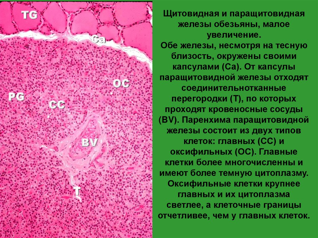 Паренхима щитовидной железы. Аденома паращитовидной железы гистология. Гиперплазия околощитовидной железы. Гиперплазия паращитовидных желез. Гиперплазия паращитовидных желез гистология.