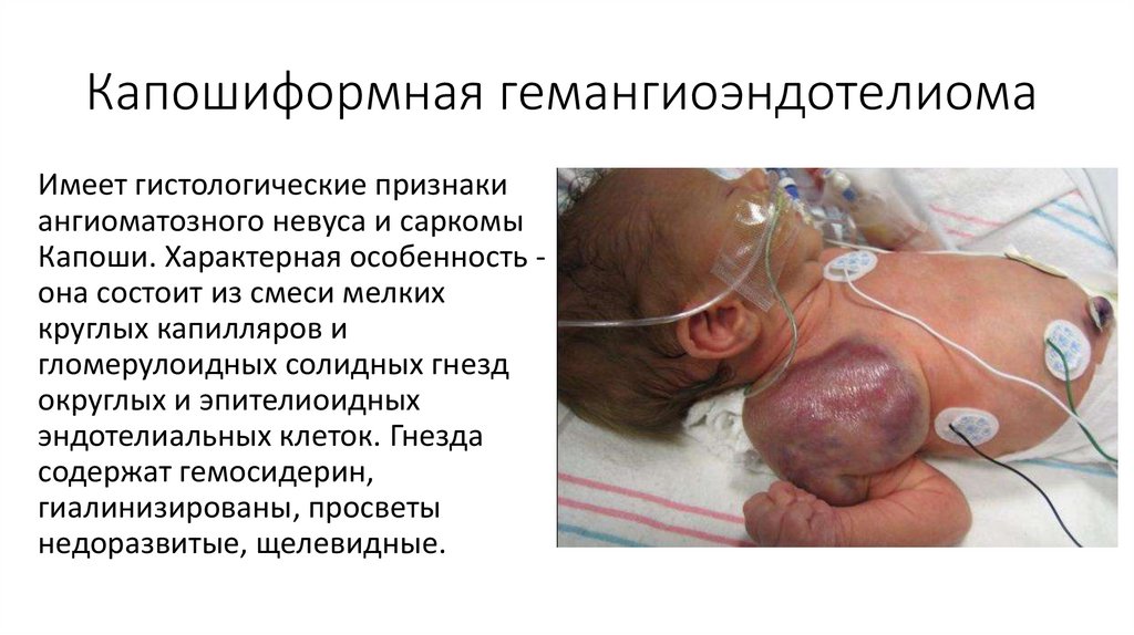 Капошиформная гемангиоэндотелиома