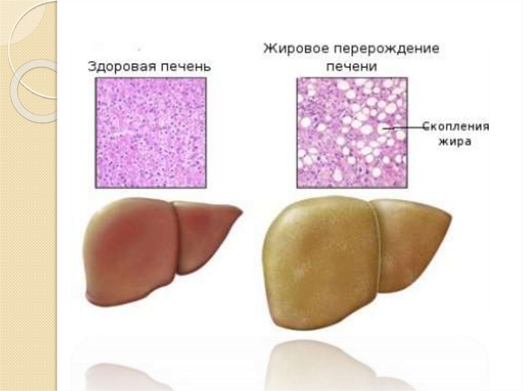 Жировая дистрофия печени - презентация онлайн