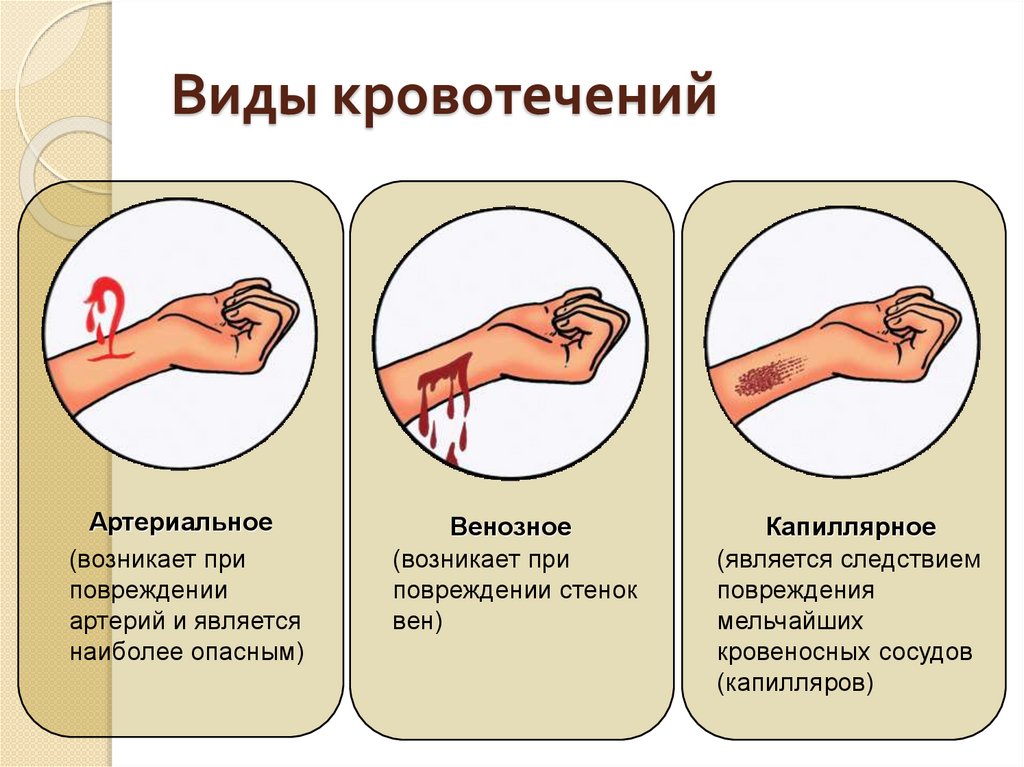 К какому виду кровотечений относится. Типы кровотечений в зависимости от типа поврежденного сосуда. Артериальное,венозное капилляр ое кровотечение. Как отличить венозное и артериальное кровотечение первая помощь. Виды кровотечения в зависимости от вида поврежденного сосуда.