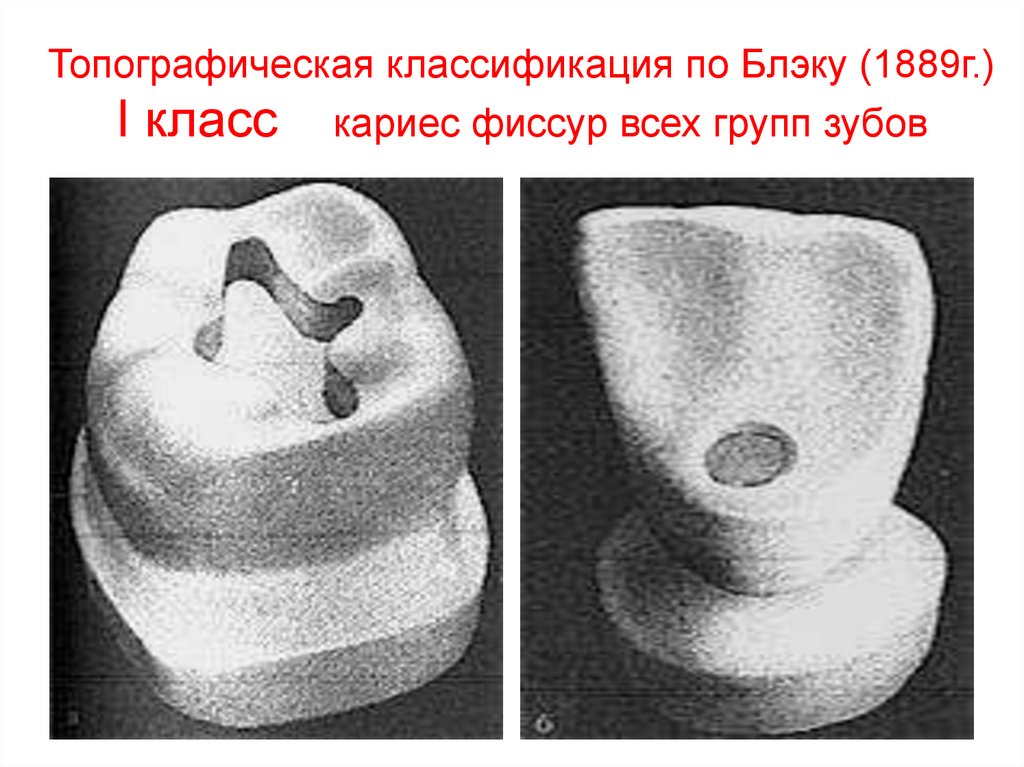 Классы по блэку в стоматологии в картинках