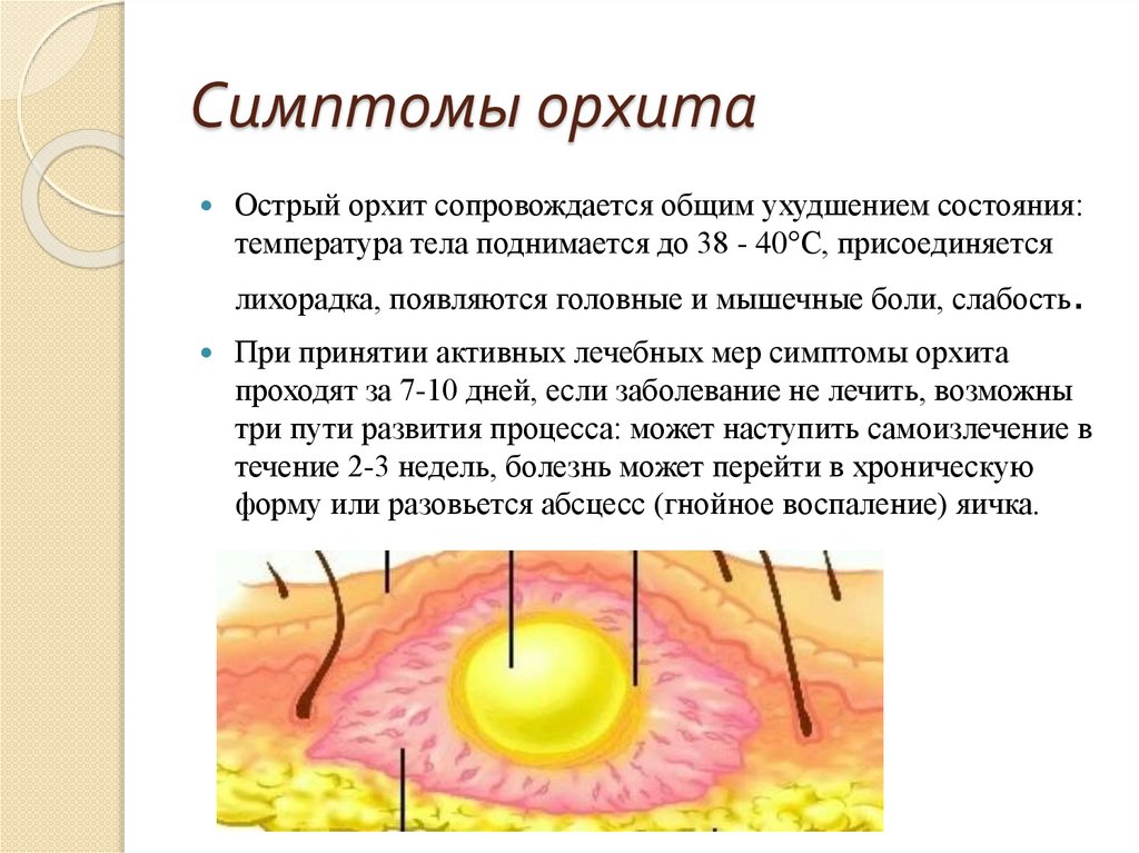 Воспаление яичек лечение. Орхит (воспаление яичка). Орхит это воспаление семенников.