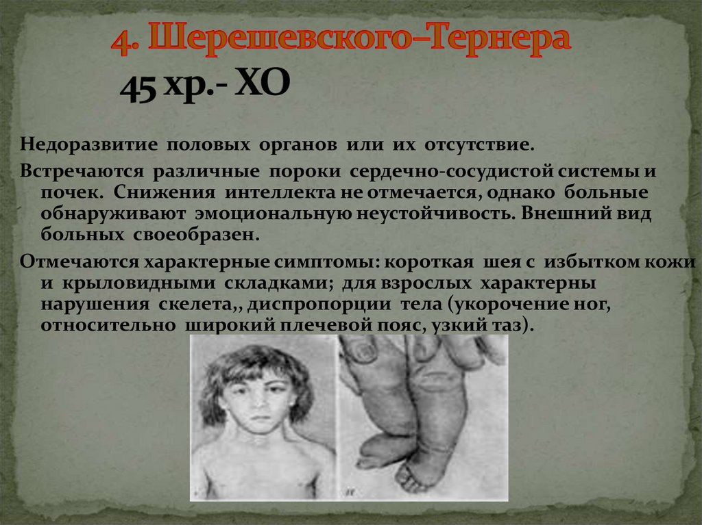4. Шерешевского–Тернера 45 хр.- ХО