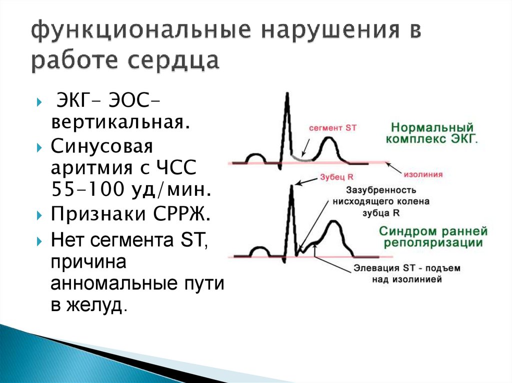 Синдром wpw сердца