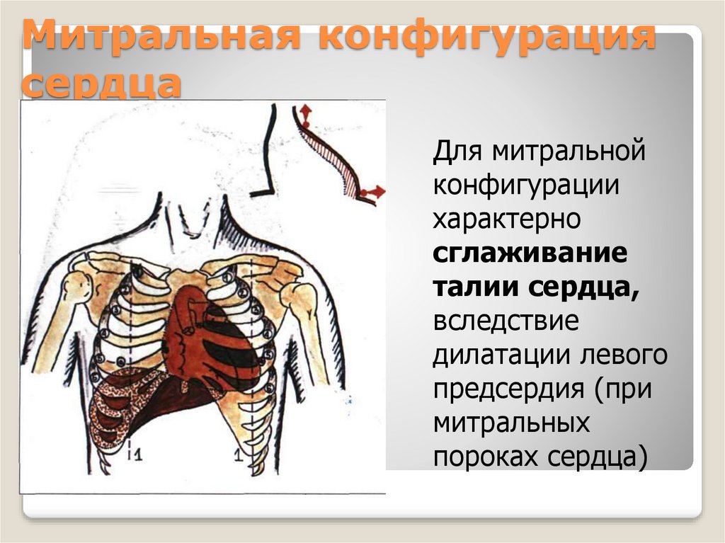 Аортальная конфигурация сердца. Митральная конфигурация сердца. Бычье сердце конфигурация сердца. Контурная перкуссия сердца конфигурация сердца. Конфигурация сердца при ГБ.