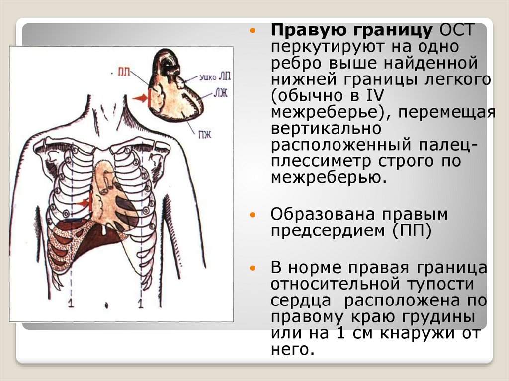 Перкуссия сердца схема