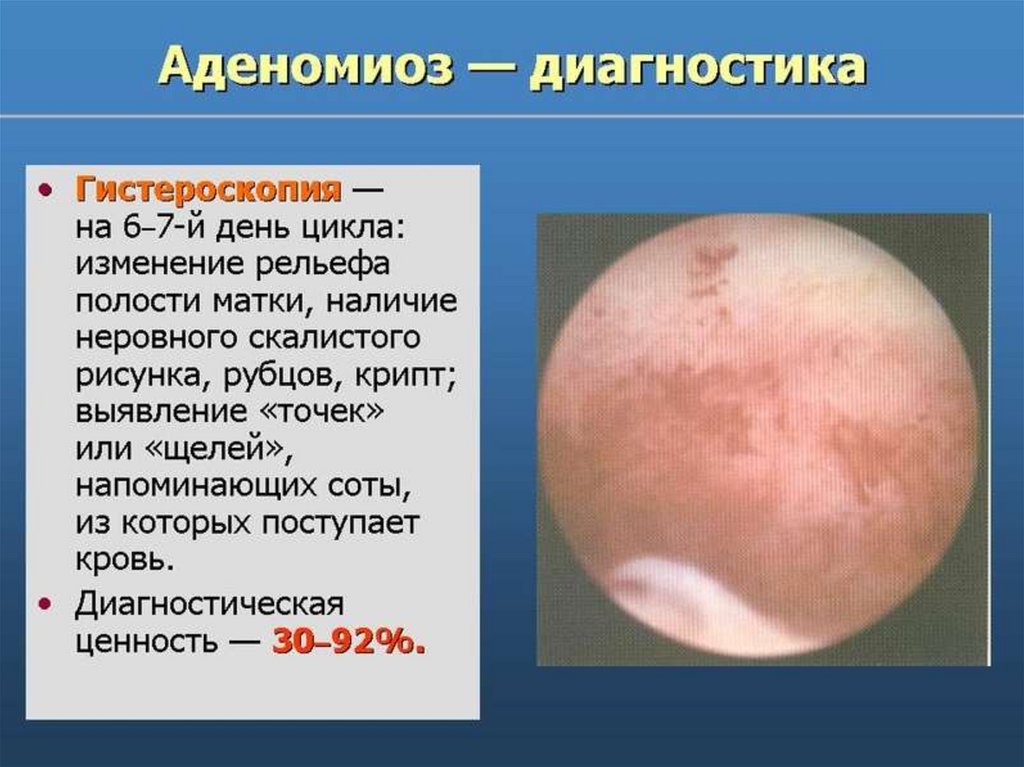 Эндометриоз - презентация онлайн