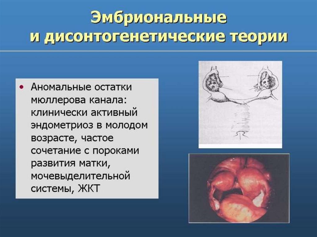 Эндометриоз - презентация онлайн