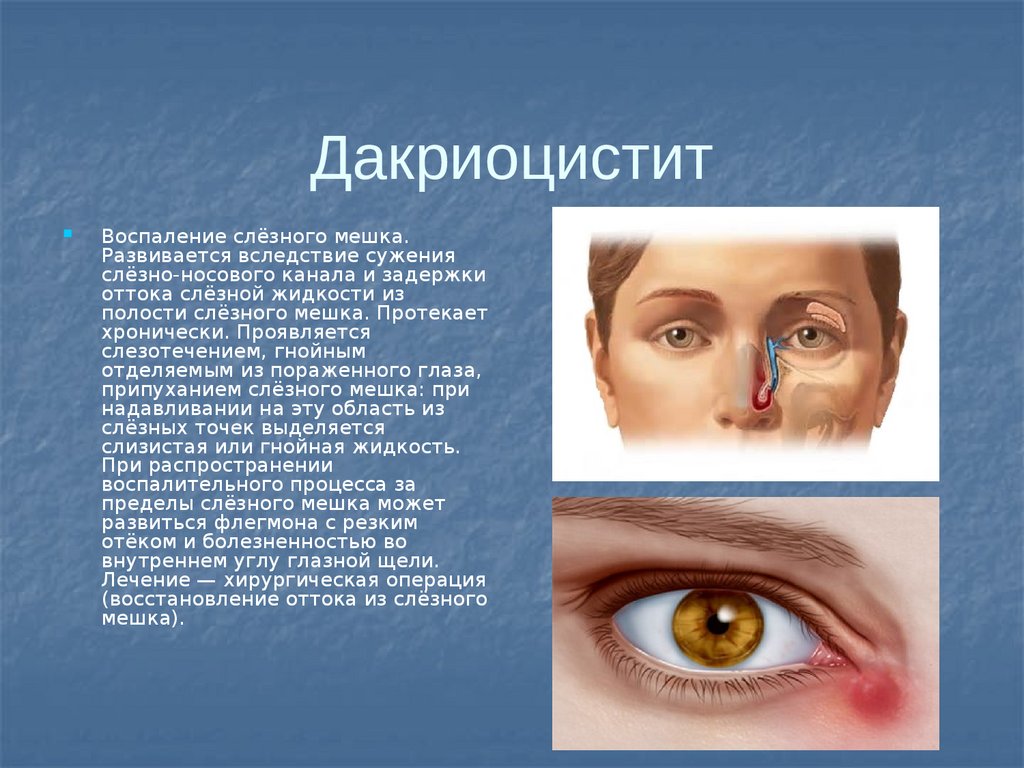 Орви и глаза. Осложнения хронического Гнойного дакриоцистита. Заболевание слезного аппарата дакриоцистит. Хламидийный дакриоцистит.