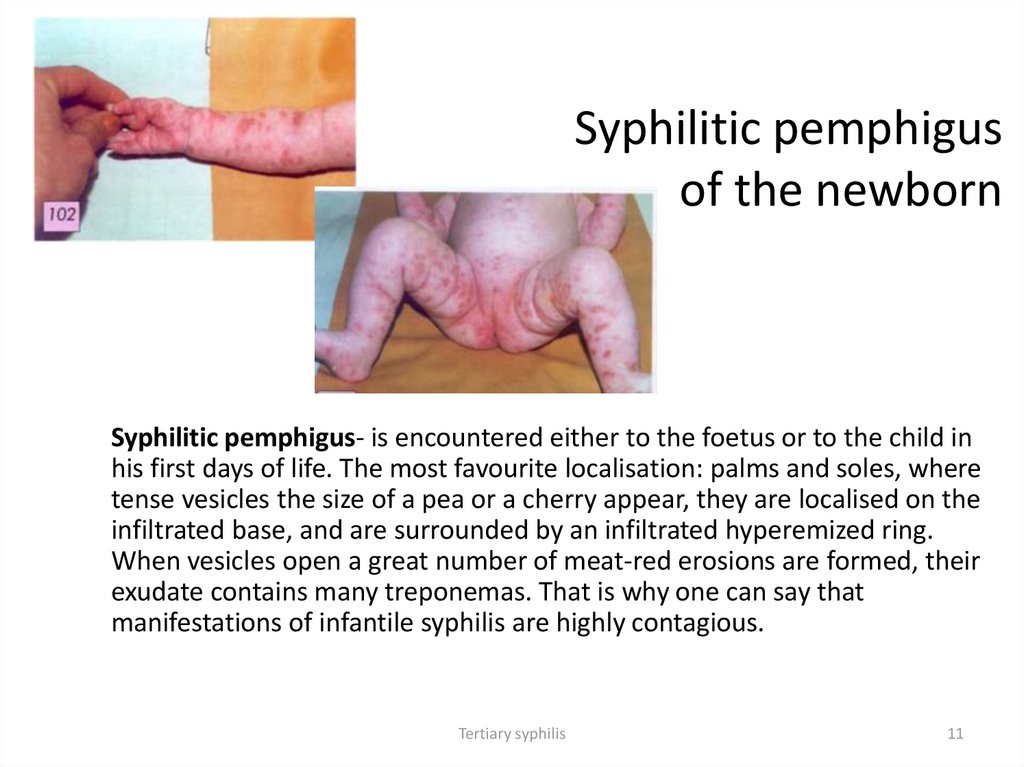 Syphilitic pemphigus of the newborn