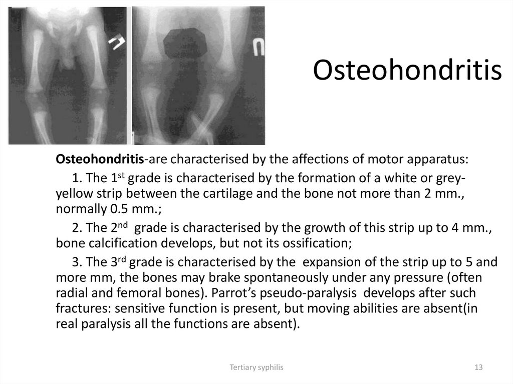 Osteohondritis