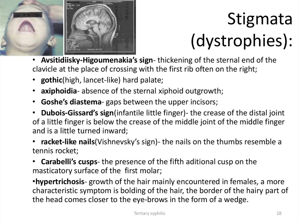 Stigmata (dystrophies):