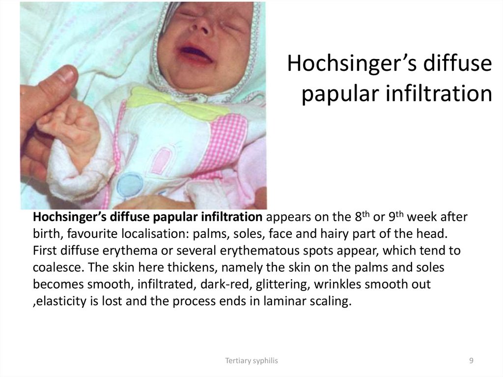 Hochsinger’s diffuse papular infiltration