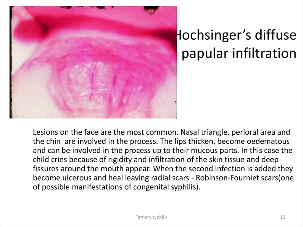 Hochsinger’s diffuse papular infiltration