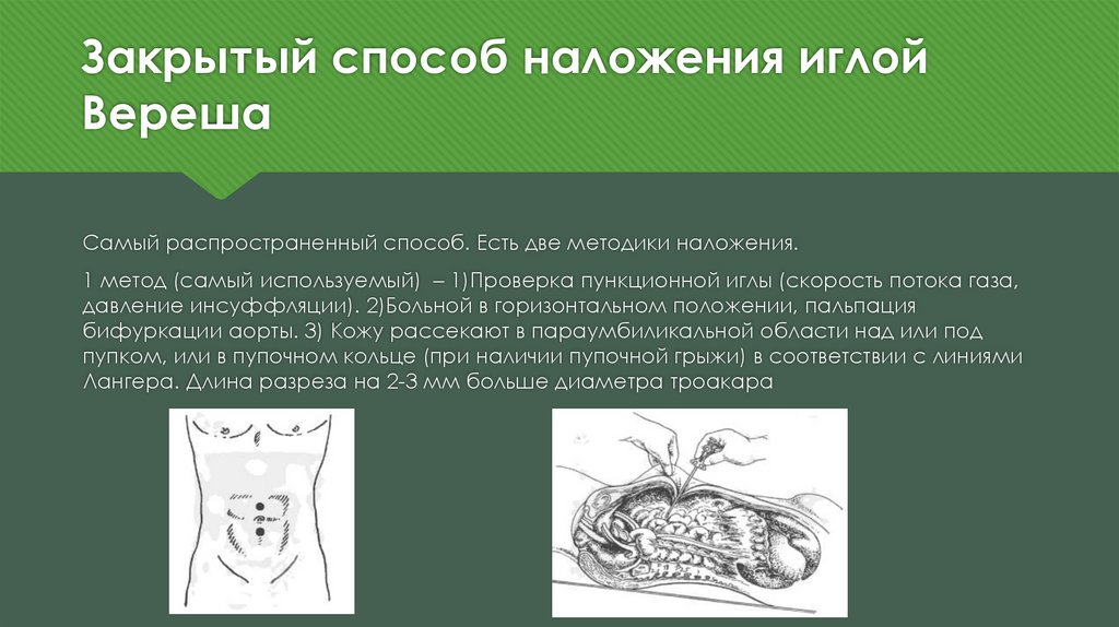 Способ наложения. Пункция брюшной полости иглой Вереша. Карбоксиперитонеум наложен иглой Вереша. Осложнения иглой Вереша.